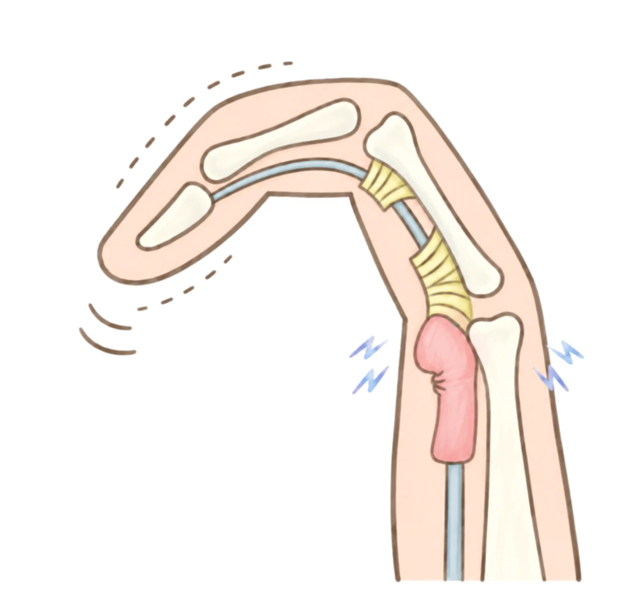 曲げた指の断面のイラスト。骨に沿って腱が走り、腱鞘の手前で腱がふくらんでいる